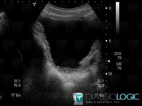 Cystite, Vessie, Echographie
