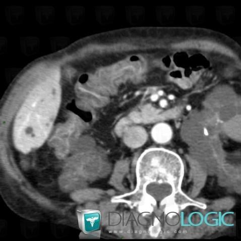 Cytomegalovirus colitis, Colon, CT