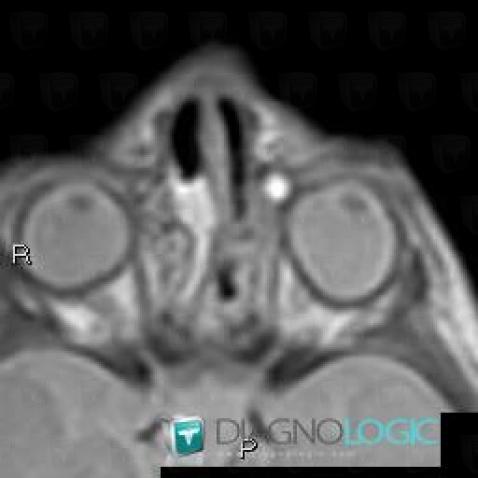 Dacryocystocele, Eye, MRI