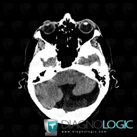 Dandy-Walker malformation, Posterior fossa, CT