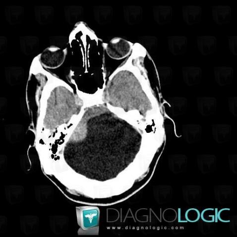 Dandy-Walker malformation, Posterior fossa, CT