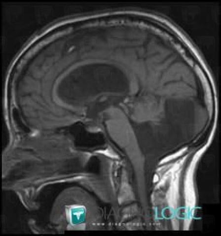 Dandy-Walker malformation, Posterior fossa, MRI