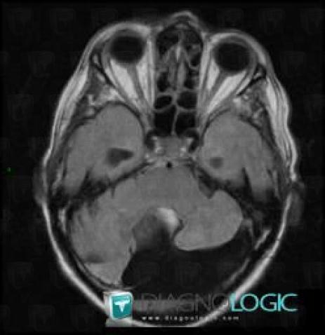 Dandy-Walker malformation, Posterior fossa, MRI