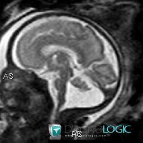 Dandy-Walker malformation, Posterior fossa, MRI