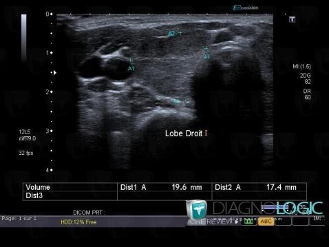 De Quervain's thyroiditis, Thyroid / Parathyroid, US