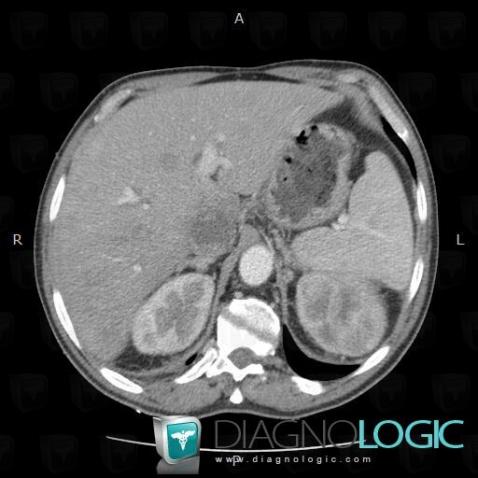 Deep venous thrombosis, Inferior vena cava, CT