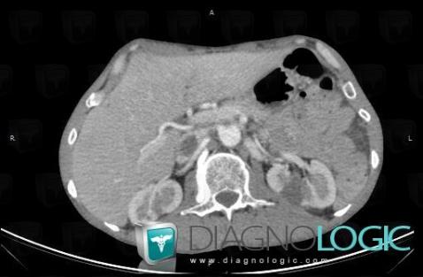 Deep venous thrombosis, Inferior vena cava, CT