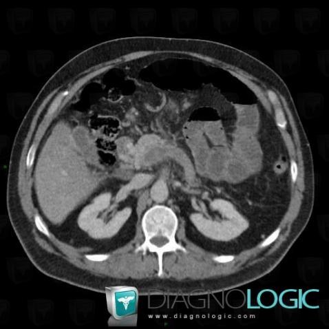 Deep venous thrombosis, Other veins - Abdomen, CT