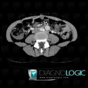 Deep venous thrombosis, Other veins - Abdomen, CT