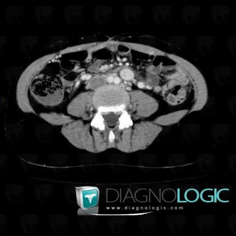 Deep venous thrombosis, Other veins - Abdomen, CT