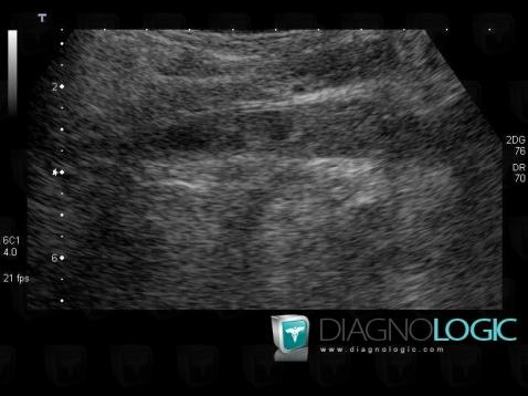 Deep venous thrombosis, Other veins - Abdomen, US