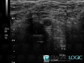 Deep venous thrombosis, Veins - Thigh, US
