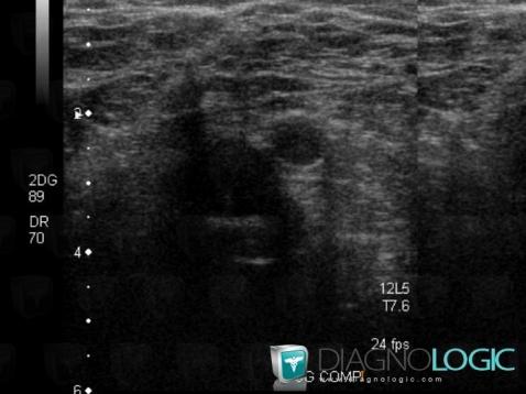 Deep venous thrombosis, Veins - Thigh, US
