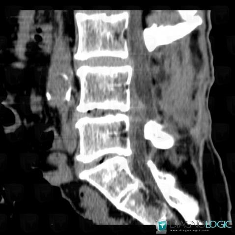 Degenerative disk disease, Vertebral body / Disk, CT