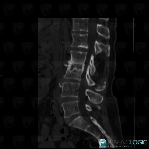 Degenerative disk disease, Vertebral body / Disk, CT