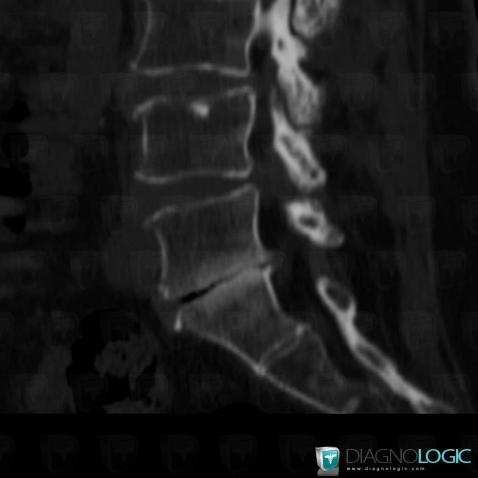 Degenerative disk disease, Vertebral body / Disk, CT
