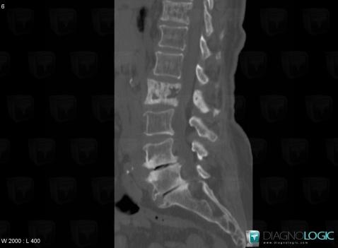 Degenerative disk disease, Vertebral body / Disk, CT