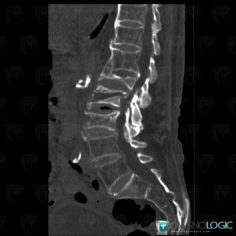Radiology case : Vertebral fracture (CT) - Diagnologic
