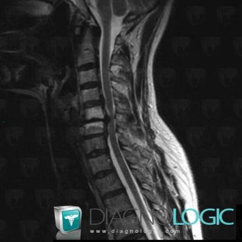 Degenerative disk disease, Vertebral body / Disk, MRI