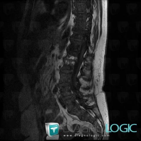 Degenerative disk disease, Vertebral body / Disk, MRI