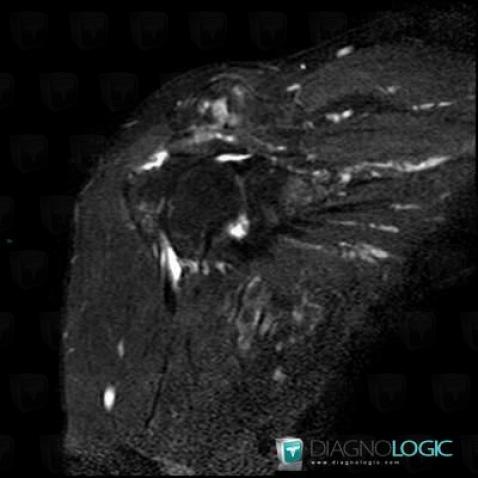 Degenerative joint disease, Acromioclavicular joint, MRI