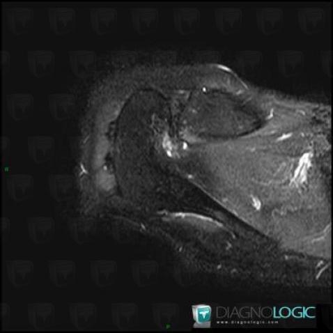 Degenerative joint disease, Acromioclavicular joint, MRI