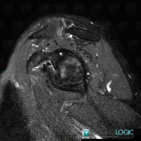 Degenerative joint disease, Acromioclavicular joint, MRI