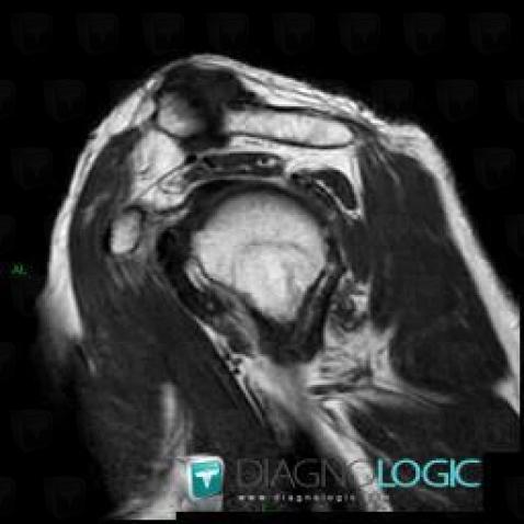 Degenerative joint disease, Acromioclavicular joint, MRI