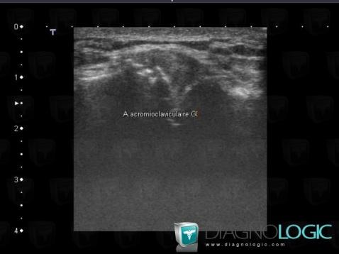 Degenerative joint disease, Acromioclavicular joint, US