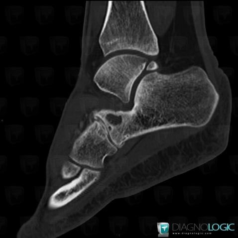 Degenerative joint disease, Calcaneus, Mid tarsal joints, CT