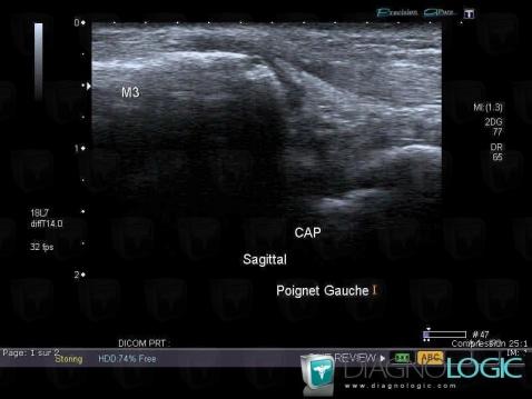 Degenerative joint disease, Carpometacarpal joint, US