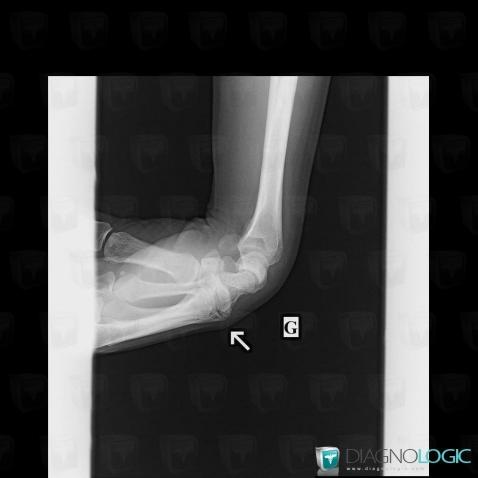 Degenerative joint disease, Carpometacarpal joint, X rays