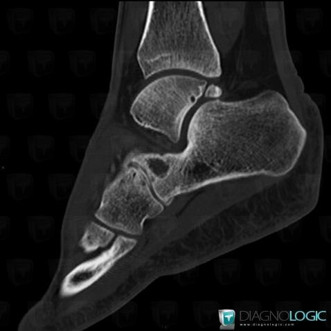 Degenerative joint disease, Cuboid, CT
