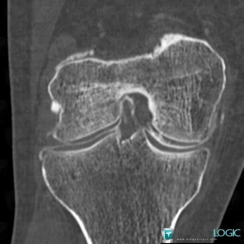 Degenerative joint disease, Femorotibial joints - Intercondylar notch, CT