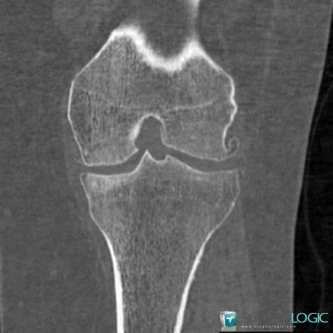 Degenerative joint disease, Femorotibial joints - Intercondylar notch, CT