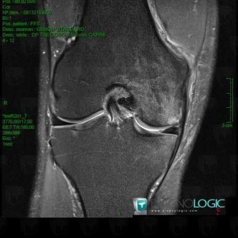 Degenerative joint disease, Femorotibial joints - Intercondylar notch, MRI