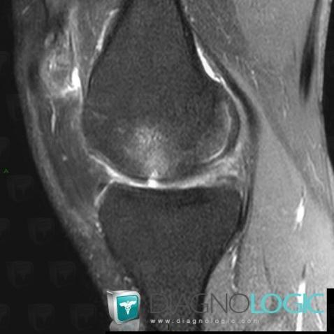 Degenerative joint disease, Femorotibial joints - Intercondylar notch, MRI