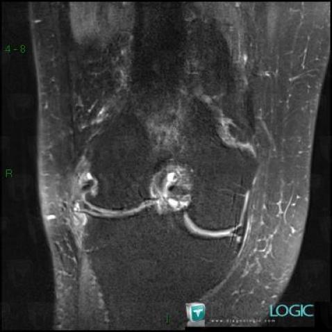 Degenerative joint disease, Femorotibial joints - Intercondylar notch, MRI