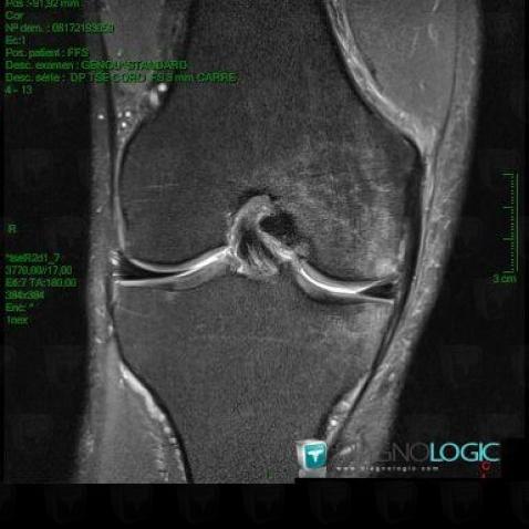 Degenerative joint disease, Femur - Distal part, Tibia - Proximal part, MRI