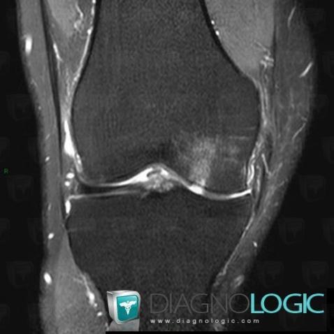 Degenerative joint disease, Femur - Proximal part, MRI