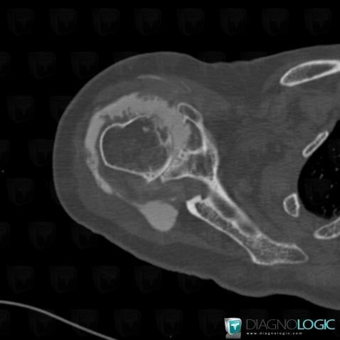 Degenerative joint disease, Gleno humeral joint, CT