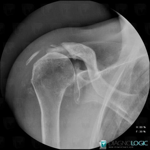 Degenerative joint disease, Gleno humeral joint, X rays