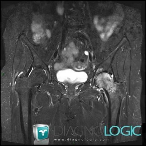 Degenerative joint disease, Ilium, Femur - Proximal part, MRI