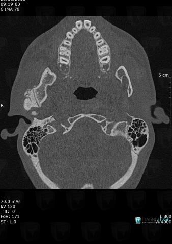 Degenerative joint disease, Mandible, CT