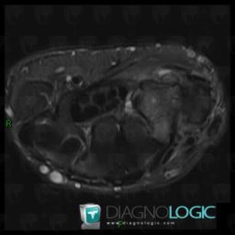 Degenerative joint disease, Other carpal bones, Mediocarpal joint, MRI