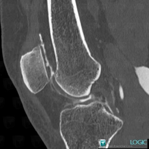 Degenerative joint disease, Patellofemoral joint, CT