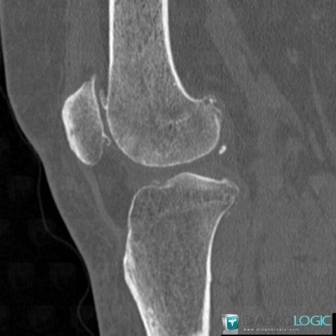 Degenerative joint disease, Patellofemoral joint, CT