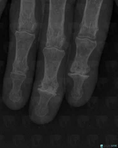 Degenerative joint disease, Phalanx / Sesamoid bones - Hand, Interphalangeal joint - Hand, X rays