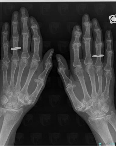Degenerative joint disease, Phalanx / Sesamoid bones - Hand, Interphalangeal joint - Hand, X rays