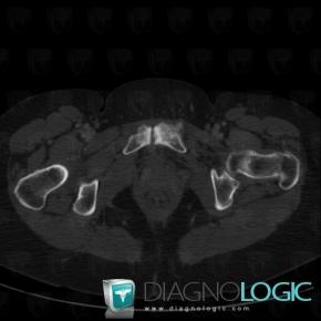 Degenerative joint disease, Pubic symphysis, CT